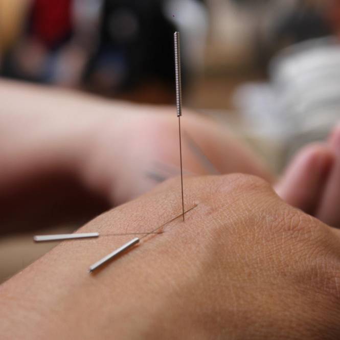 acupuncture for quitting smoking